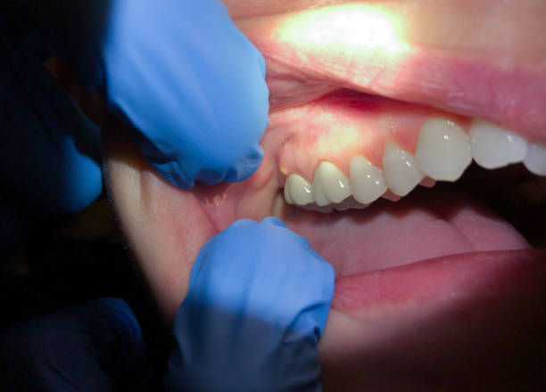 Best Emergency Gum Treatment in Mooreland, OK